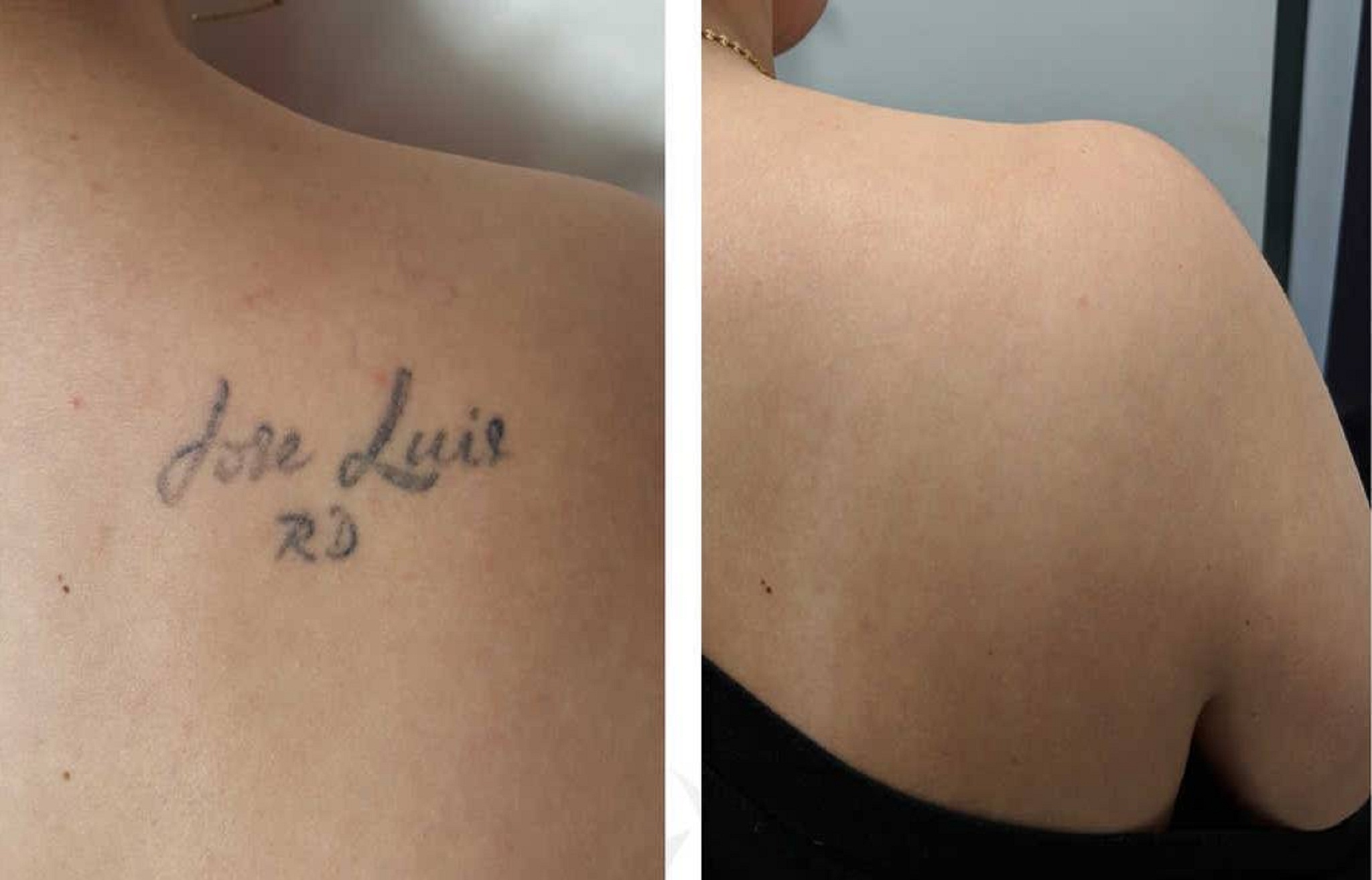 Tattoo Removal Facts and Questions Everybody Gets Wrong