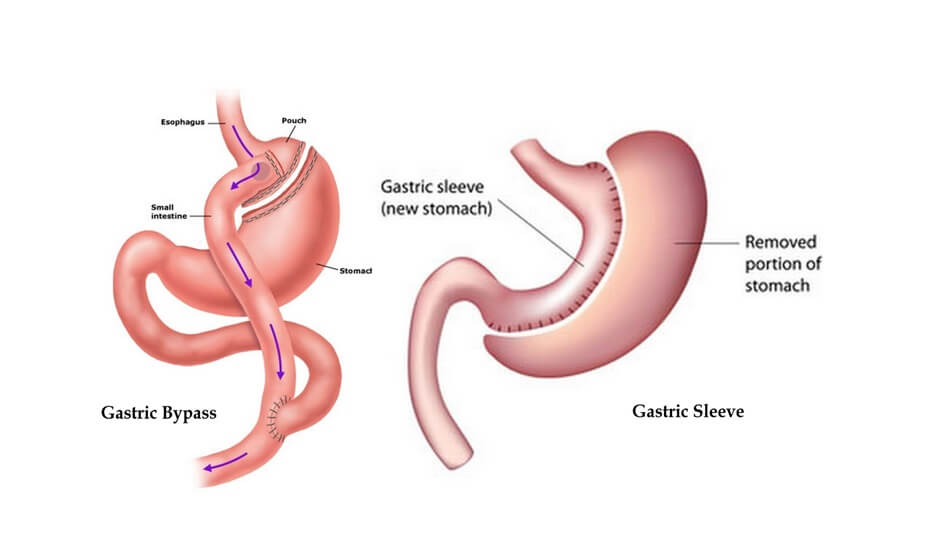 Key Difference Between Gastric Sleeve and Gastric Bypass Surgery