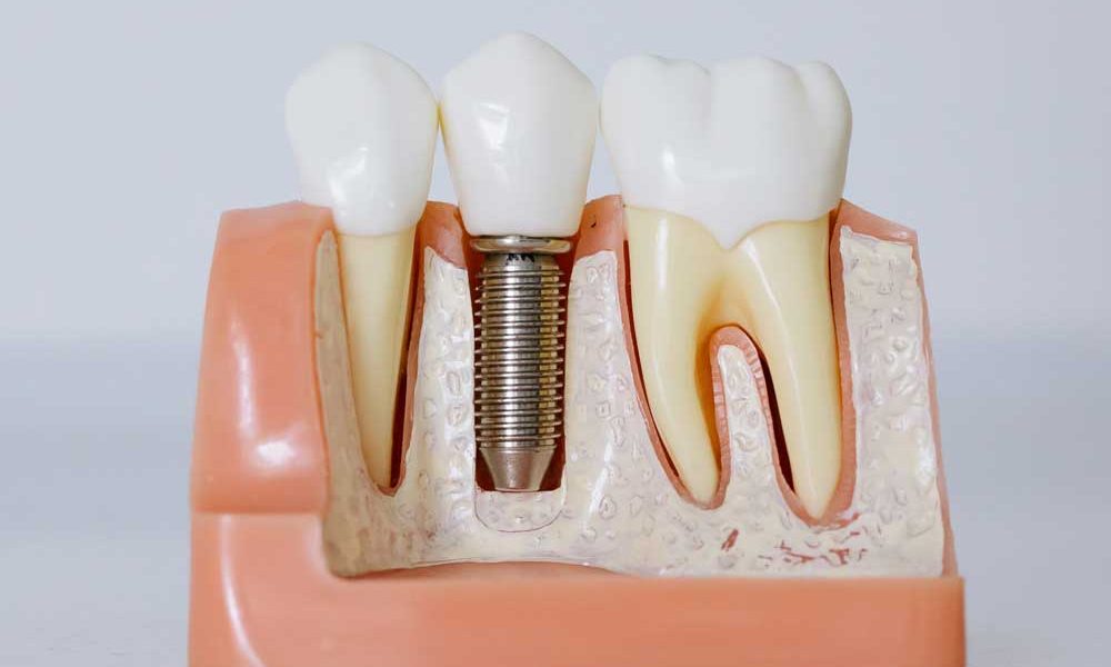Tooth Replacement Options