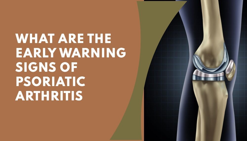 What Are The Early Warning Signs of Psoriatic Arthritis hospitalninojesus