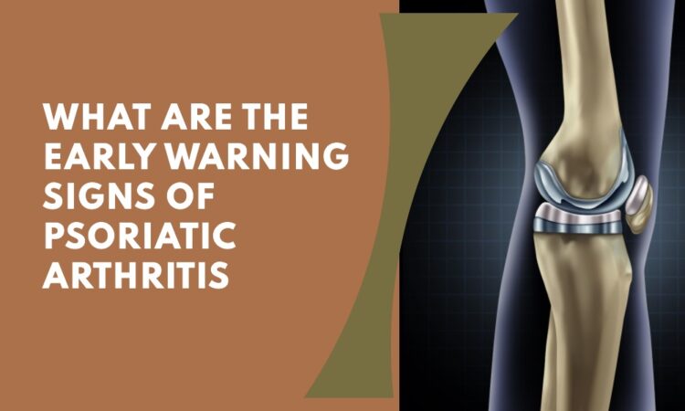 What Are The Early Warning Signs of Psoriatic Arthritis - Hospital Nino ...
